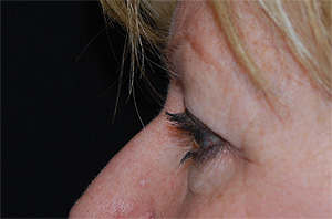 Blepharoplasty Before & After Patient #25106