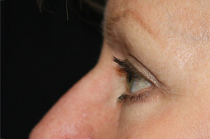 Blepharoplasty Before & After Patient #25106