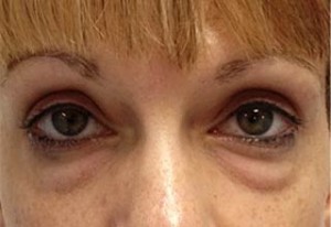 Blepharoplasty Before & After Patient #25107