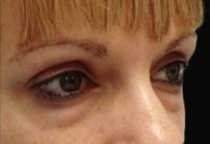 Blepharoplasty Before & After Patient #25107