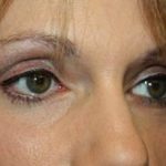 Blepharoplasty Before & After Patient #25107
