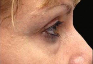 Blepharoplasty Before & After Patient #25107