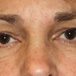 Blepharoplasty Before & After Patient #25126