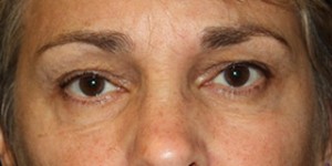 Blepharoplasty Before & After Patient #25126