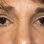 Blepharoplasty Before & After Patient #25126