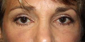 Blepharoplasty Before & After Patient #25126