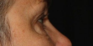 Blepharoplasty Before & After Patient #25126