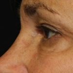 Blepharoplasty Before & After Patient #25126