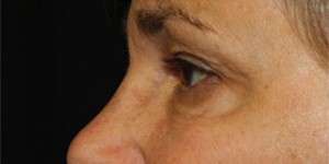 Blepharoplasty Before & After Patient #25126