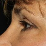 Blepharoplasty Before & After Patient #25126