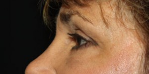 Blepharoplasty Before & After Patient #25126