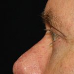 Blepharoplasty Before & After Patient #25127