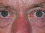 Blepharoplasty Before & After Patient #25127