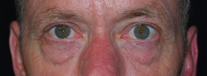 Blepharoplasty Before & After Patient #25127