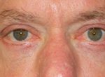 Blepharoplasty Before & After Patient #25127