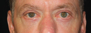 Blepharoplasty Before & After Patient #25127