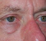 Blepharoplasty Before & After Patient #25127