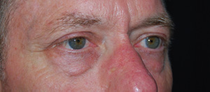 Blepharoplasty Before & After Patient #25127