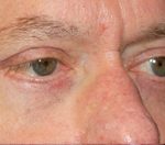 Blepharoplasty Before & After Patient #25127