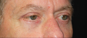 Blepharoplasty Before & After Patient #25127