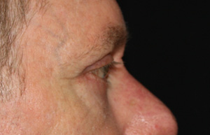 Blepharoplasty Before & After Patient #25127