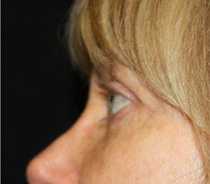 Blepharoplasty Before & After Patient #25144