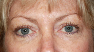 Blepharoplasty Before & After Patient #25144