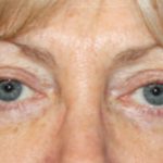 Blepharoplasty Before & After Patient #25144