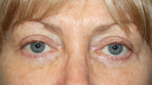 Blepharoplasty Before & After Patient #25144