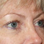 Blepharoplasty Before & After Patient #25144