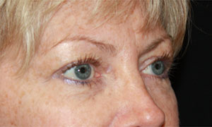 Blepharoplasty Before & After Patient #25144