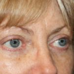 Blepharoplasty Before & After Patient #25144