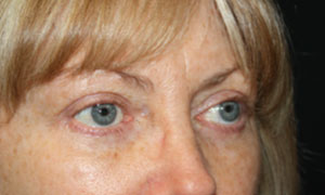 Blepharoplasty Before & After Patient #25144