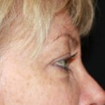 Blepharoplasty Before & After Patient #25144