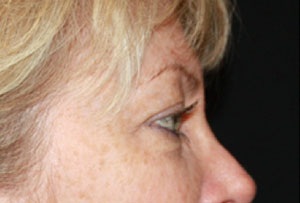 Blepharoplasty Before & After Patient #25144