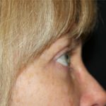 Blepharoplasty Before & After Patient #25144