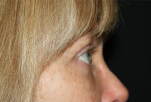 Blepharoplasty Before & After Patient #25144