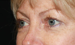 Blepharoplasty Before & After Patient #25144