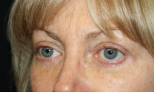 Blepharoplasty Before & After Patient #25144