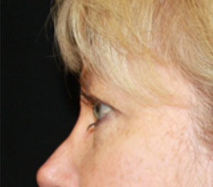 Blepharoplasty Before & After Patient #25144