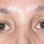 Blepharoplasty Before & After Patient #25146