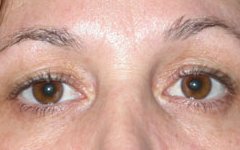 Blepharoplasty Before & After Patient #25146