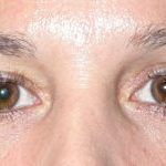 Blepharoplasty Before & After Patient #25146