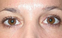 Blepharoplasty Before & After Patient #25146