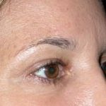 Blepharoplasty Before & After Patient #25146