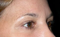 Blepharoplasty Before & After Patient #25146