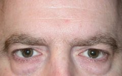 Blepharoplasty Before & After Patient #25161