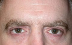 Blepharoplasty Before & After Patient #25161