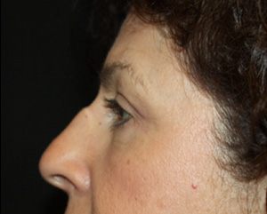 Blepharoplasty Before & After Patient #24944