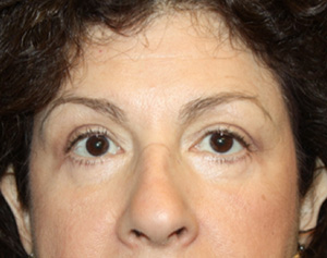 Blepharoplasty Before & After Patient #24944